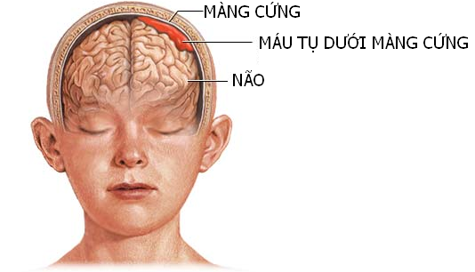 Tụ máu dưới màng cứng - Hình ảnh minh họa